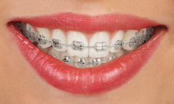 https://www.smileviewdental.com/sesame_media/images/sds/traditional-metal.jpg